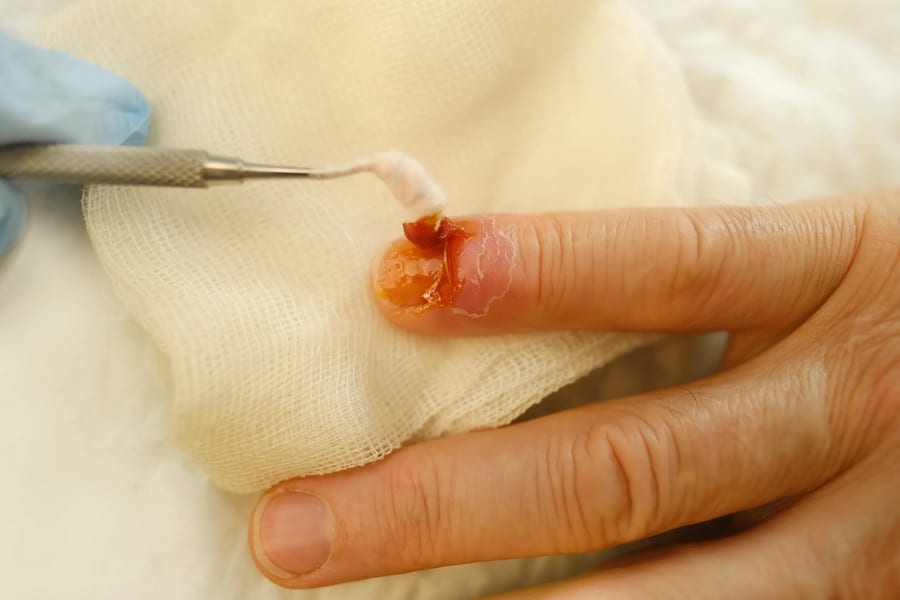 Healthcare professional performing wound debridement