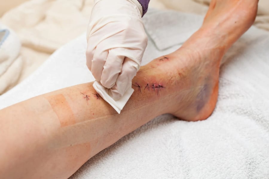 Clinician preparing and refashioning wound edges